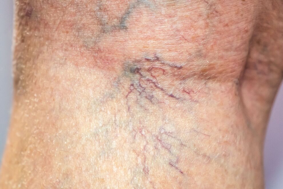 Varicose veins on the body