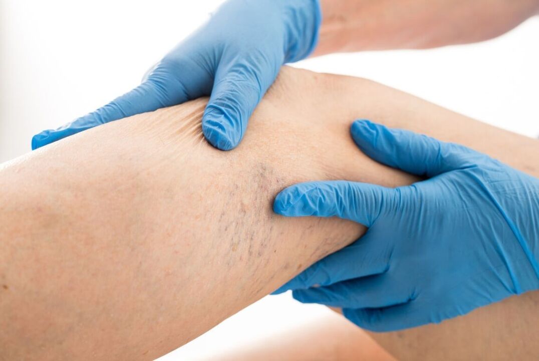 Varicosa Carin clinical disease
