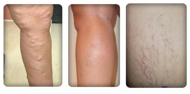 Phase of varicose veins
