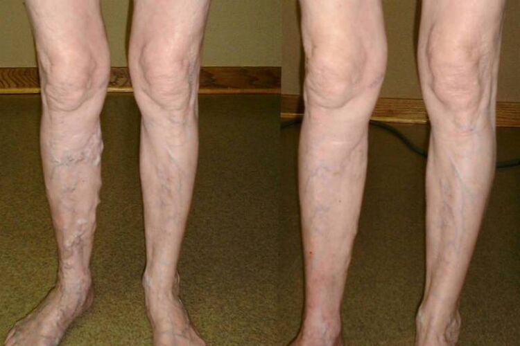 Varicose veins in men