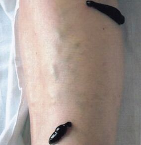 Irudotherapy as a method for the treatment of varicose veins