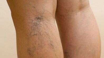 The causes of varicose veins