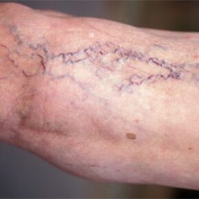 Varicose veins