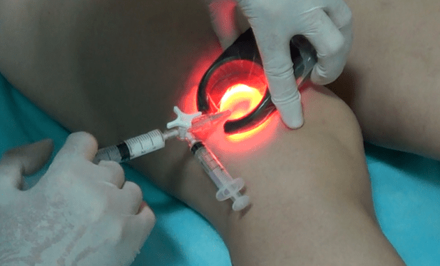 Sclerotherapy is an effective method for treating varicose veins on the legs