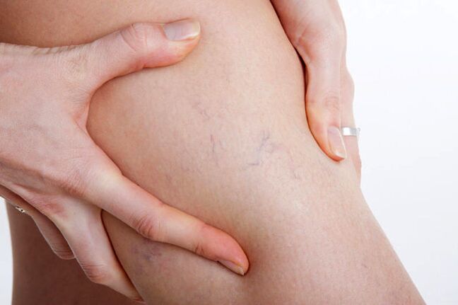 The first appearances of varicose veins on the leg